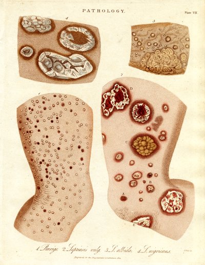Pathologische Hautzustände: Schurigie; Leprahaut; Pallada und Impetigo von John Pass