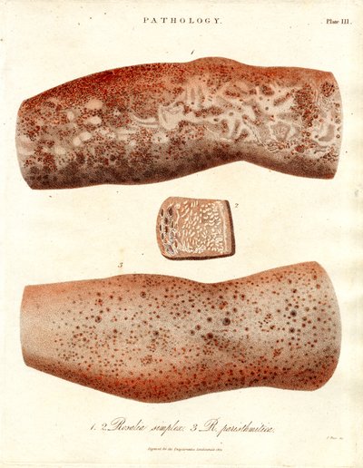 Hautausschläge - Roseola simplex und Roseola paristhmitica von John Pass
