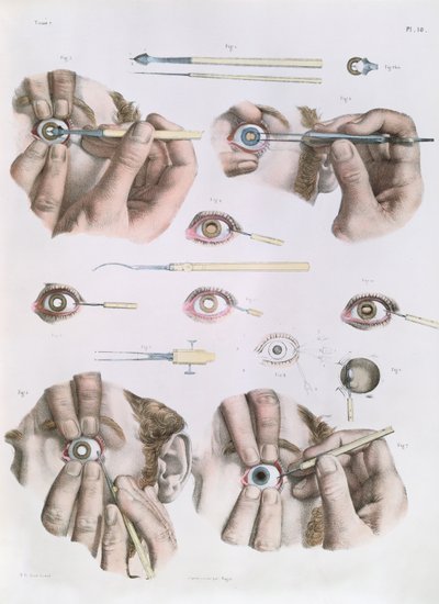 Operation am Auge, Platte aus 