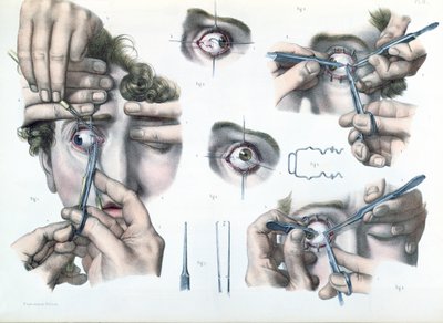 Operation an einem Strabismus, Platte aus 