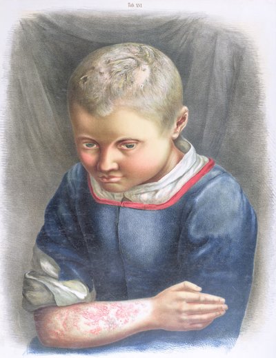 Favus, aus einem Buch von Daniel Cornelius Danielssen (1815-94) 1892 von Norwegian School