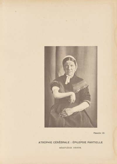 Zerebrale Atrophie: Partielle Epilepsie, rechte Hemiplegie von Paul Marie Léon Regnard