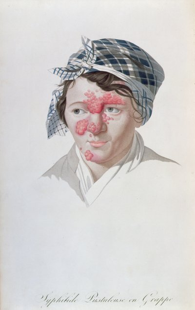 Syphilitische Clusterpusteln, aus einem Buch von Baron Jean Louis Alibert (1768-1837), 1838 von Salvadore Tresca