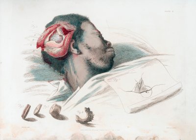 Ansicht der Wunde im Schädel nach Trepanation und Entfernung des zersplitterten Knochens unten links, 1821 von Thomas Landseer