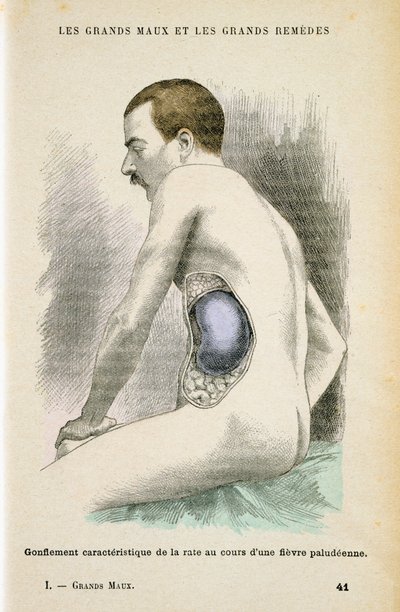 Typische vergrößerte Milz eines Malariapatienten, ca. 1890 von Unbekannt