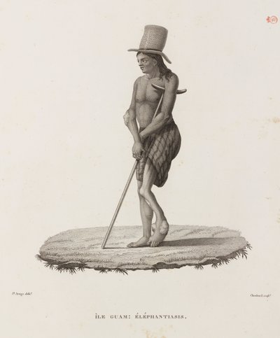 Krankheiten, Tropische Krankheiten Mann mit Elephantiasis, Guam von Unbekannt