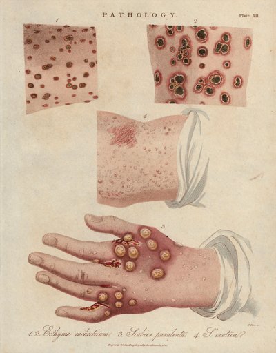 Hautgeschwür, eitrige Krätze und Krätze verursacht durch eine Sarcoptes scabiei Milbe - Lithographie von John Pass, veröffentlicht in „Encyclopedia Londinensis“ von John Wilkes, J.Adlard Ausgabe, London von Unbekannter Künstler