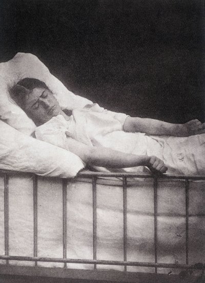Hystero-Epilepsie - Tetanismus-Anfall in „Photographische Ikonographie der Salpêtrière: Dienst von Herrn Charcot“ von Paul Regnard und Bourneville von Unknown artist