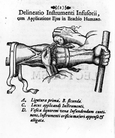 Intravenöse Injektion mit einer Klystierblase. von J. D. Mayor, „Surgery Infusoria“, Kilonii 1667 von Unknown artist