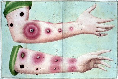 Symptome der Pockenkrankheit, die einen Ausbruch von Pusteln auf der Haut verursachen. Medizinische Tafel aus dem „Vaccination Treat“ von Luigi Sacco, Mailand von Unknown artist