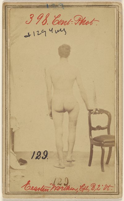Bruch des oberen Drittels des Oberschenkelknochens. Erastus Worthen, Corp Co. B. 2. Vermont Vols. Alter 25 - Wohnort Stockbridge VT. von Unknown artist