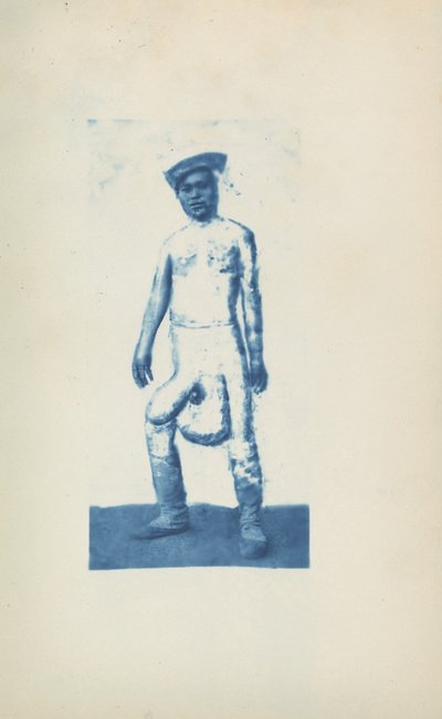 Elephantiasis, ca. 1870er Jahre (Foto) von Unknown photographer