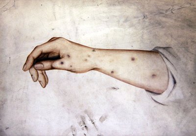 Studie eines Unterarms mit Hauterkrankung, ca. 1850 von William Lover