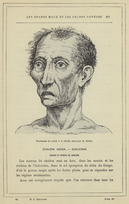 Gesichtsausdruck eines Kranken in der asphyktischen Phase der Cholera von French School