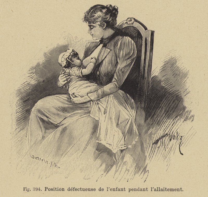 Falsche Position eines Babys beim Stillen von German School