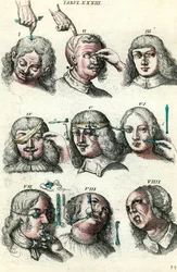 Chirurgie im 18. Jahrhundert: Trepanation und Operation an Auge und Gesicht. Stich in „Institutionis chirurgicae“ von Lorenzo Heister