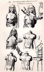Operation bei Brustkrebs, aus Armamentarii Chirurgici von Johannes Schultes, veröffentlicht in Amsterdam, 1672