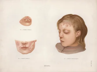 Hautkrankheiten: Herpes