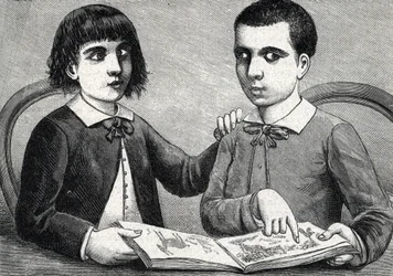 Kinder mit konvergentem und divergentem Strabismus oder Schielen (Gravur) 1888