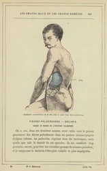 Charakteristische Milzschwellung im Verlauf eines Malariafiebers