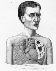 Darstellung einer Person mit Höhlen, Komplikation der Tuberkulose (Gravur)