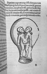 Siamesische Kinder, Illustration aus dem sogenannten Rhodion-Manuskript