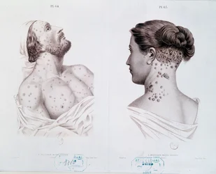 Symptome der Syphilis bei Männern und Frauen, aus einem medizinischen Buch, ca. 1850-60