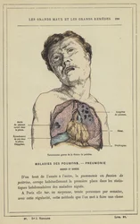 Schwere Endstadien der Brustflussigkeit