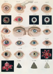 Beschreibung angeborener Augenanomalien, aus Klinische Darstellungen der Krankheiten und Bildungsfehler des menschlichen Auges, von Friedrich August von Ammon (1799-1861) 1838