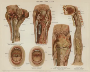 Krankheiten des Rachens