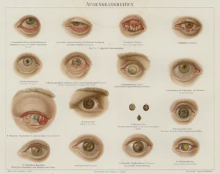 Augenerkrankungen