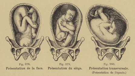 Fehllage von Babys im Mutterleib vor der Geburt
