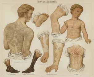 Hautkrankheiten