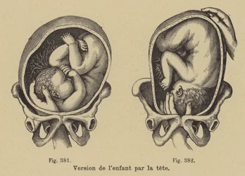 Drehen eines Babys im Mutterleib, sodass der Kopf vor der Geburt nach unten zeigt