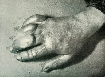Dr. Atkinsons erfrorene Hand, 5. Juli 1911