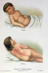 Masern und Scharlach, aus einem Familienmedizinbuch, ca. 1900