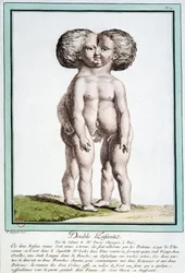 Siamesische Kinder - in „Les deviations de la nature“ von Régnault