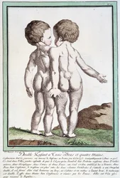 Siamesische Kinder - in „Die Abweichungen der Natur“ von Régnault