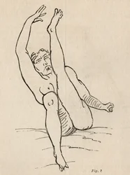 Hysterische Epilepsie, Anfall, Verrenkungen, Abb. 2 aus 