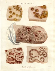 Pathologische Hautveränderungen: Varianten der Psoriasis