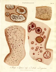 Pathologische Hautzustände: Schurigie; Leprahaut; Pallada und Impetigo