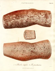 Hautausschläge - Roseola simplex und Roseola paristhmitica