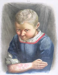 Favus, aus einem Buch von Daniel Cornelius Danielssen (1815-94) 1892