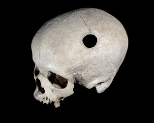 Prähistorischer Schädel mit Trepanationsspur, Museum für Nationale Altertümer