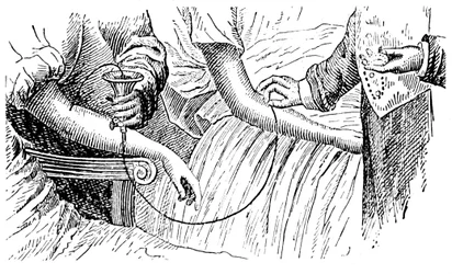 Bluttransfusion, ca. 1880