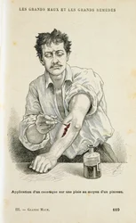 Eine Wunde mit einer antiseptischen Lösung behandeln, um 1890
