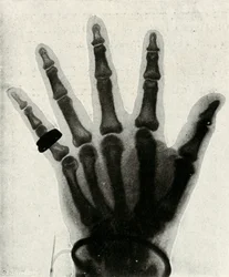 Röntgenaufnahme der Hand von H.R.H. Der Prinz von Wales