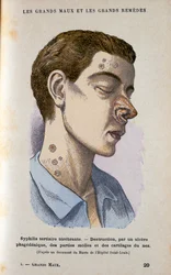 Symptome der tertiären Phase der Syphilis, ca. 19. Jahrhundert