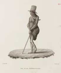 Krankheiten, Tropische Krankheiten Mann mit Elephantiasis, Guam