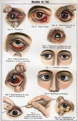 Augenkrankheiten. In „Die neue natürliche Heilung“ von F.E. Bilz.